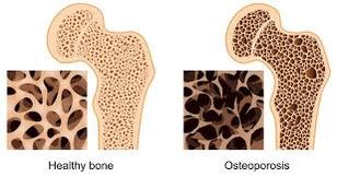kostnej osteoporózy
